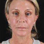 Ponytail Facelift Before & After Patient #3118