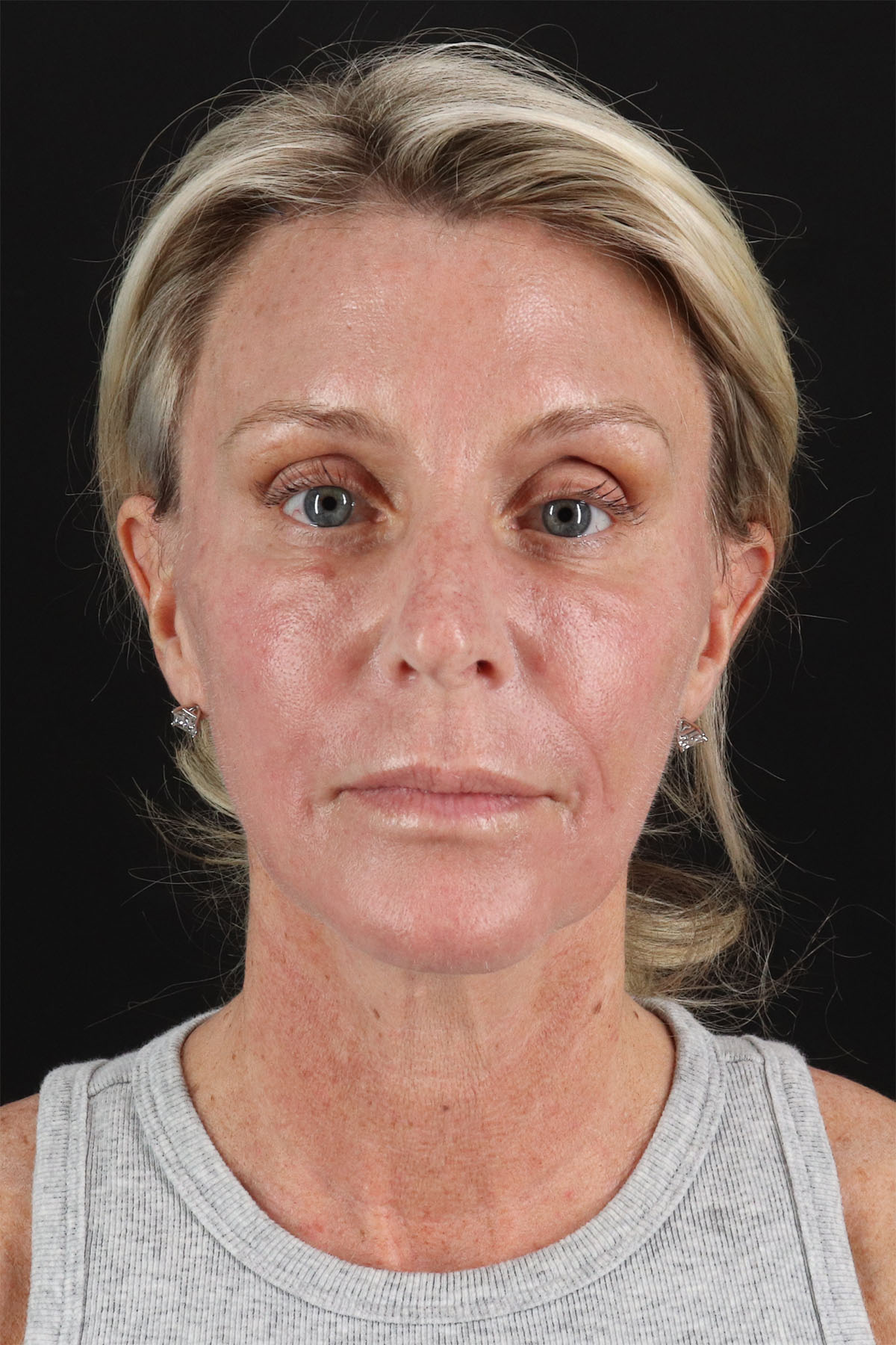 Ponytail Facelift Before & After Patient #3118