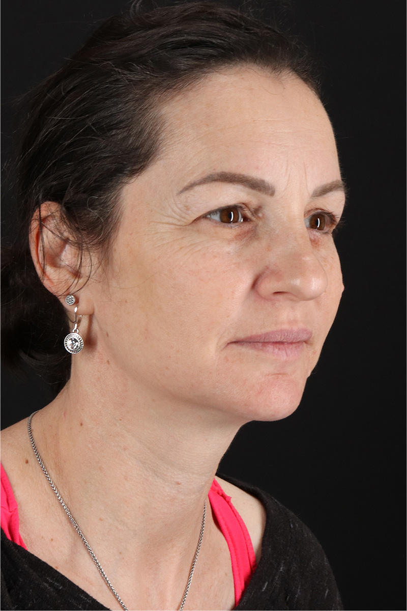 Chemical Peel Before & After Patient #3470
