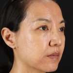 Skin Resurfacing / Laser Before & After Patient #3001