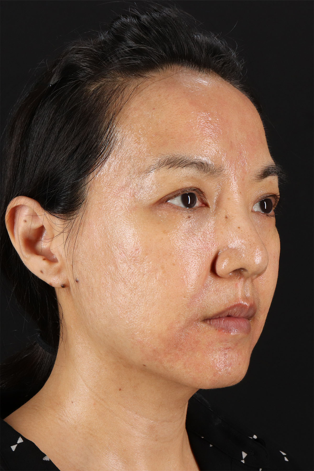 Skin Resurfacing / Laser Before & After Patient #3001