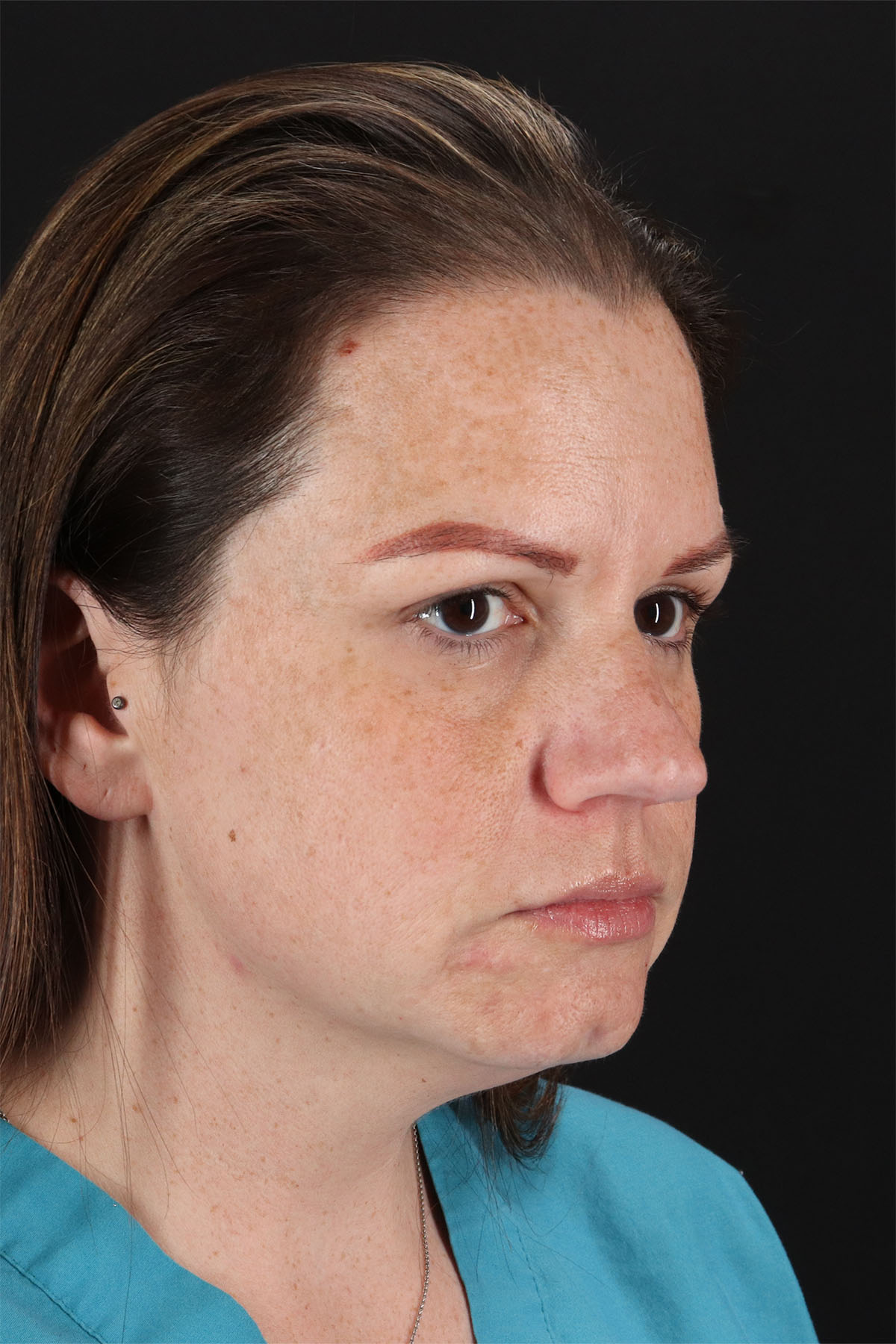 Chemical Peel Before & After Patient #3002