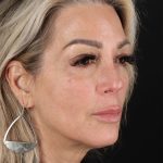 CO2 Laser Before & After Patient #3003