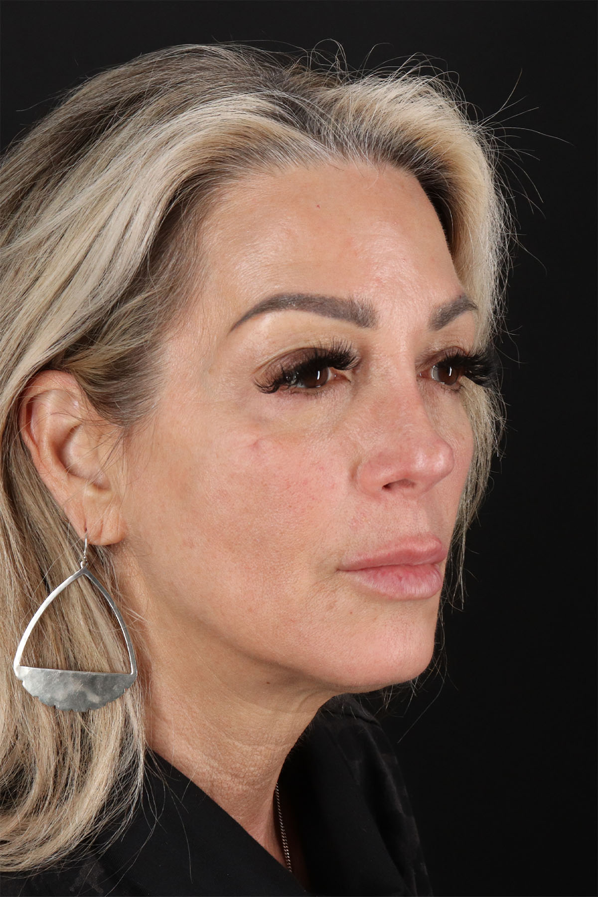 CO2 Laser Before & After Patient #3003