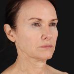Structural Fat Grafting Before & After Patient #3643