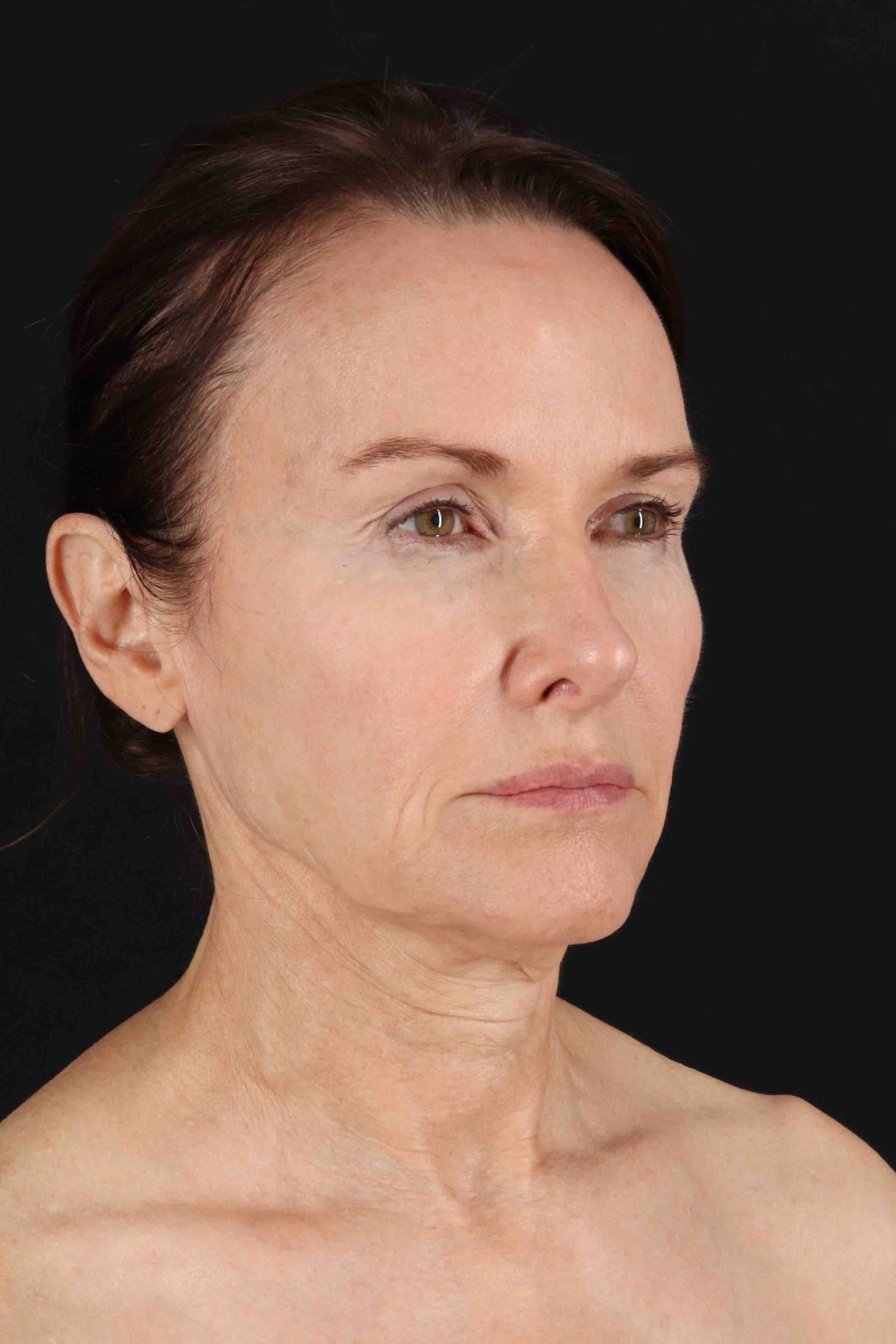 Structural Fat Grafting Before & After Patient #3643
