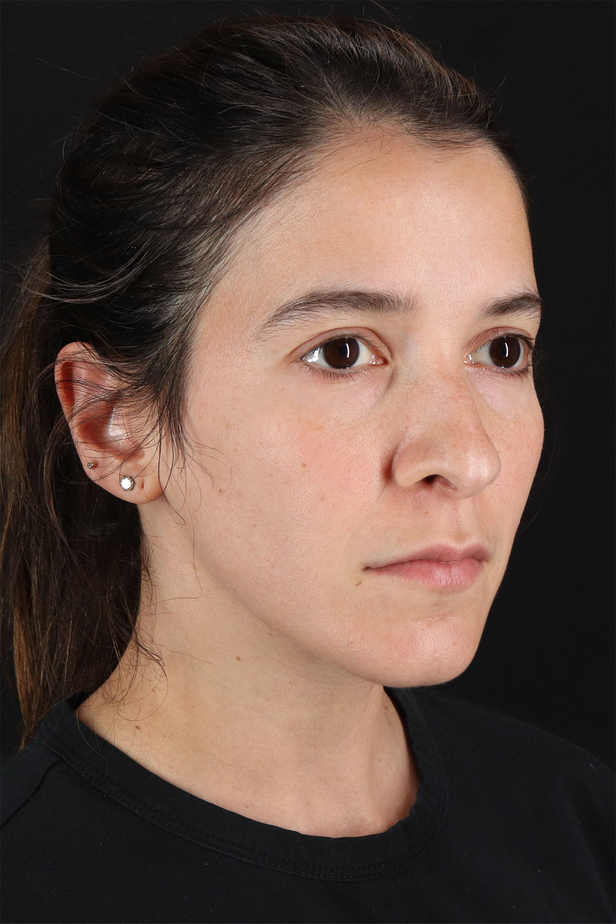 CO2 Laser Before & After Patient #3005