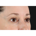 Eyelid Surgery Before & After Patient #3006