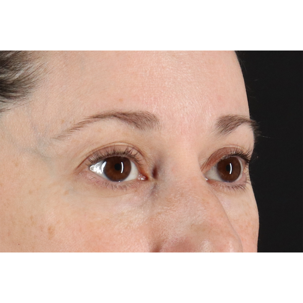 Eyelid Surgery Before & After Patient #3006