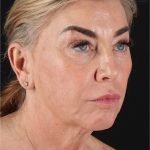 Neck Lift Before & After Patient #3476
