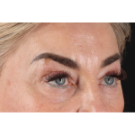 Eyelid Surgery Before & After Patient #3475