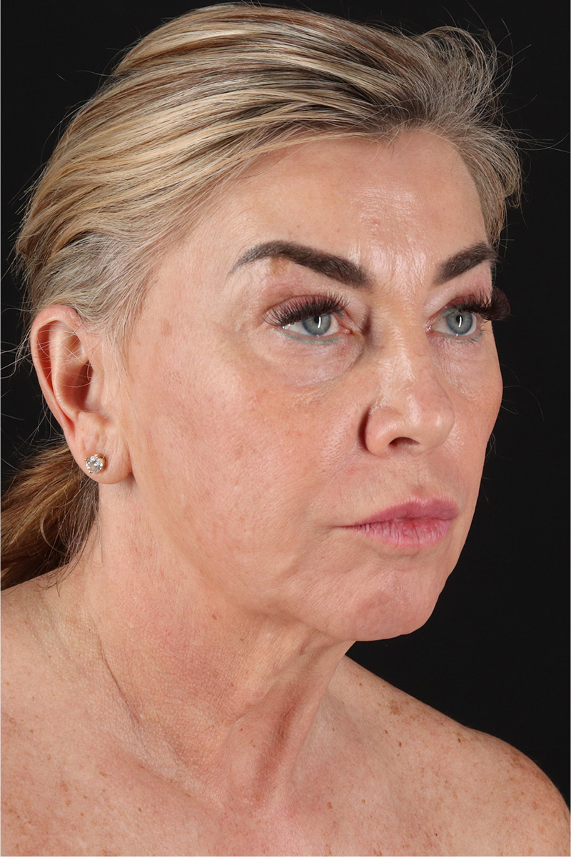 Neck Lift Before & After Patient #3476