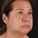 CO2 Laser Before & After Patient #3009
