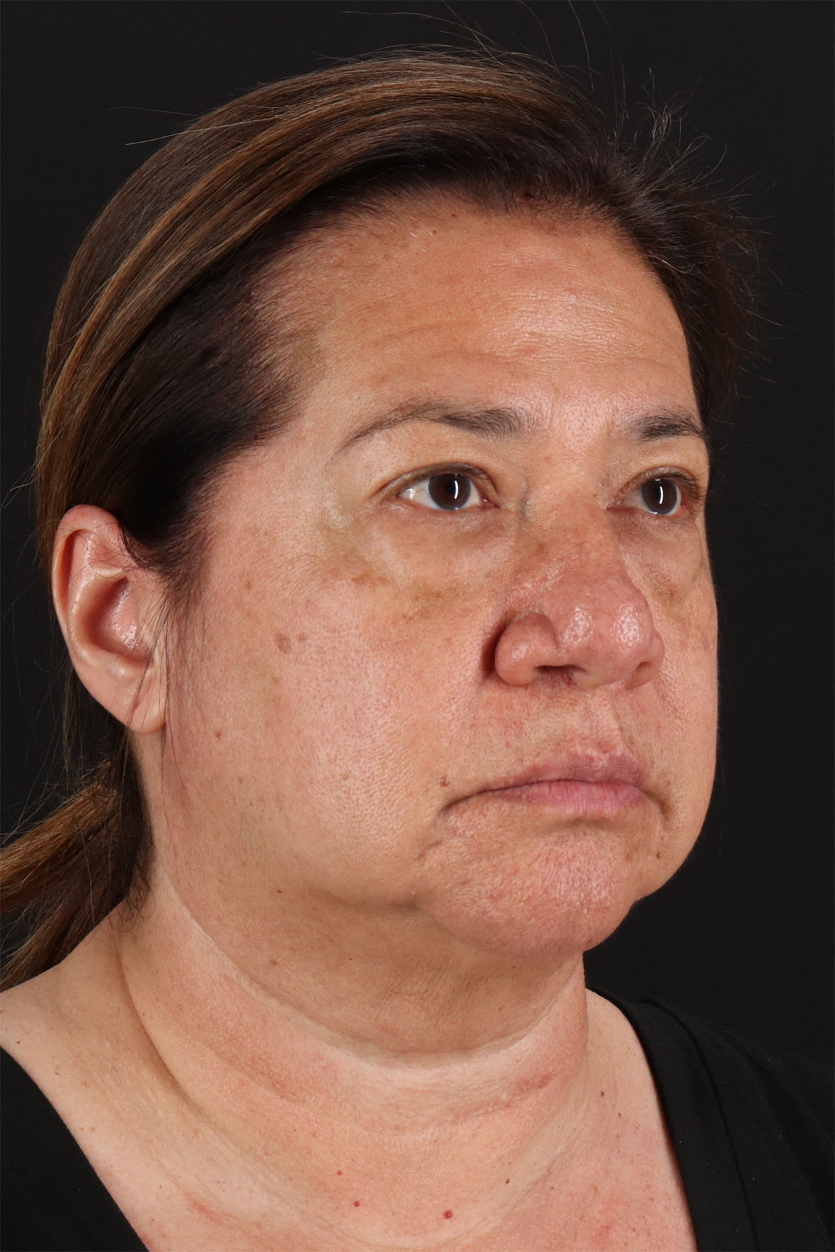 CO2 Laser Before & After Patient #3009