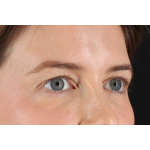 Eyelid Surgery Before & After Patient #3570