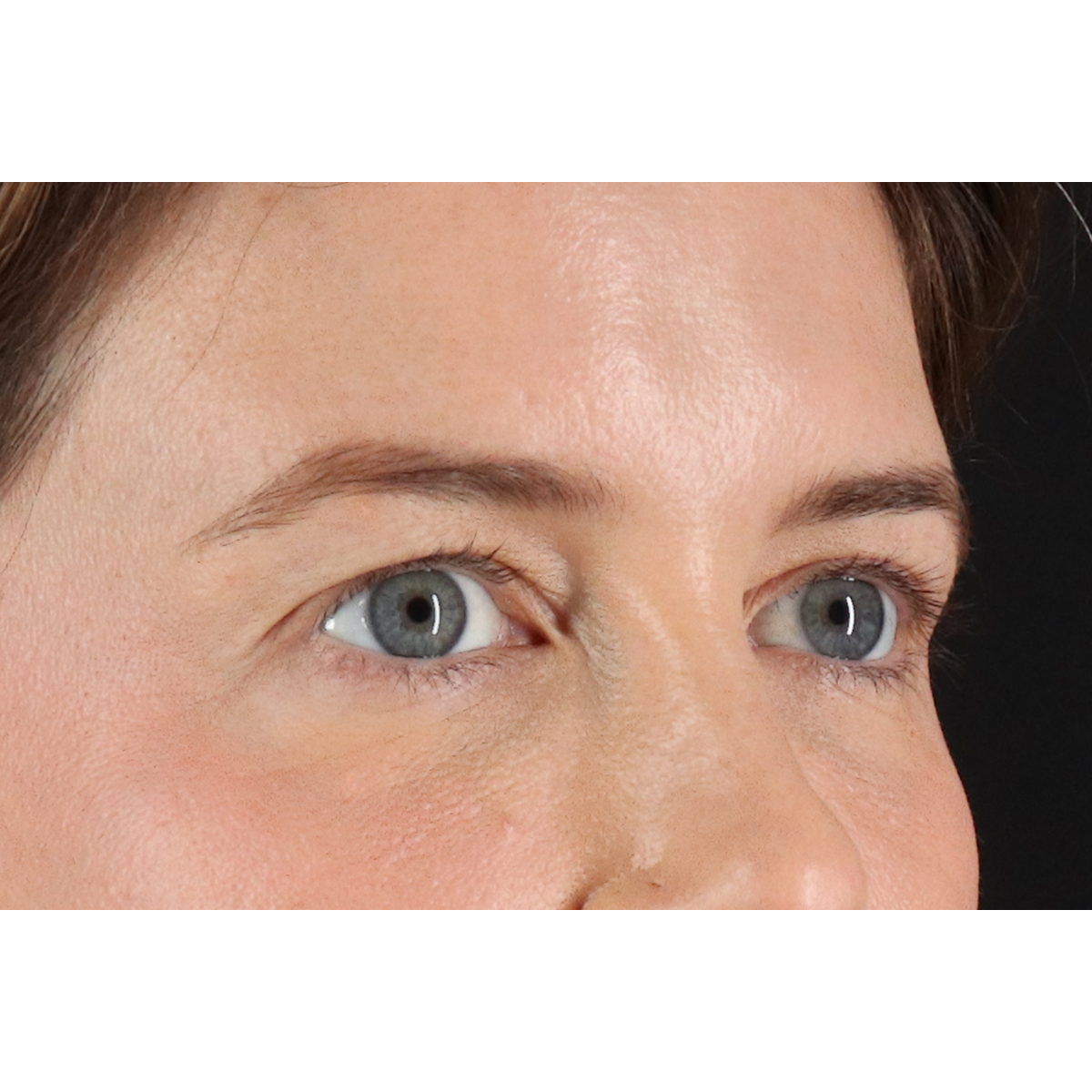 Eyelid Surgery Before & After Patient #3570