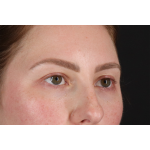 Brow Lift Before & After Patient #3111
