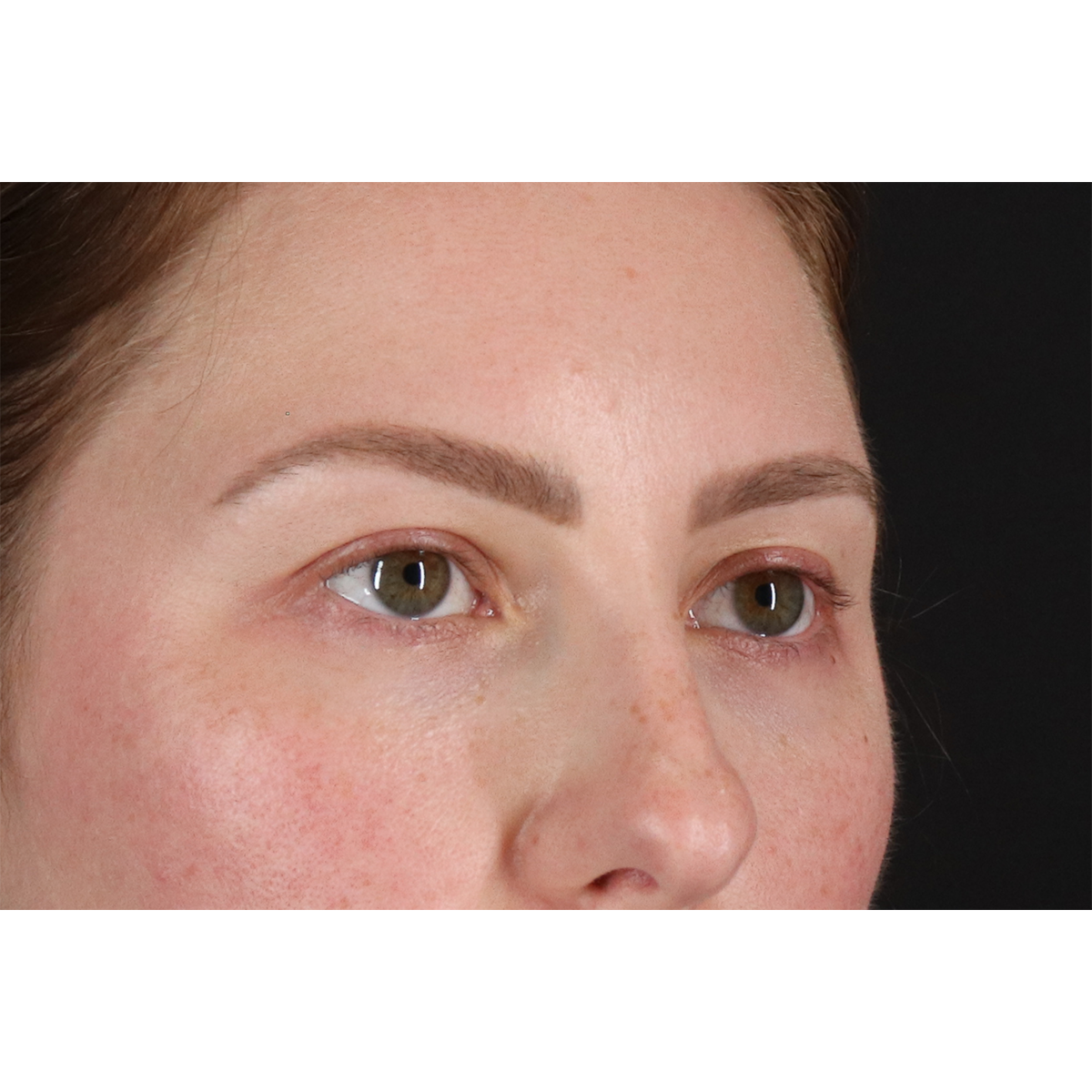 Brow Lift Before & After Patient #3111