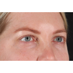 Eyelid Surgery Before & After Patient #3112