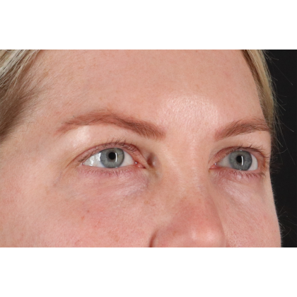 Eyelid Surgery Before & After Patient #3112