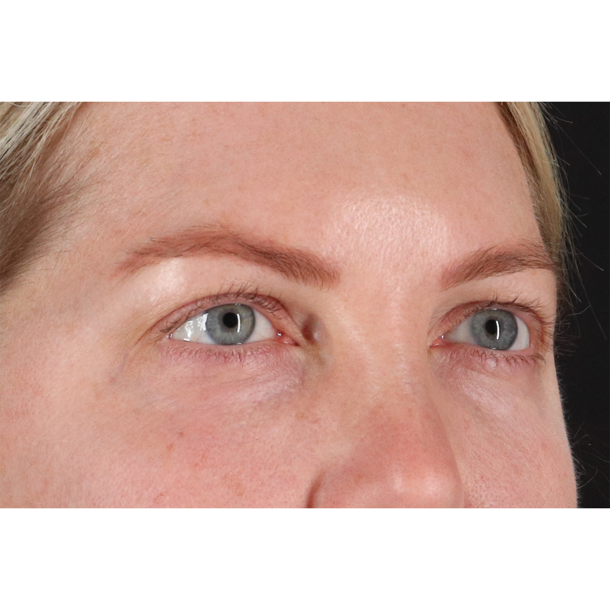 Eyelid Surgery Before & After Patient #3112