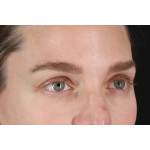 Eyelid Surgery Before & After Patient #3571