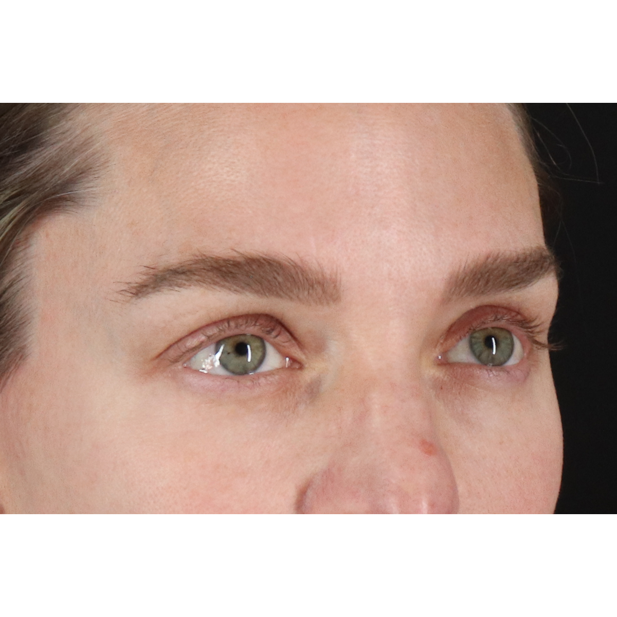 Eyelid Surgery Before & After Patient #3571