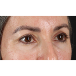 Eyelid Surgery Before & After Patient #3356