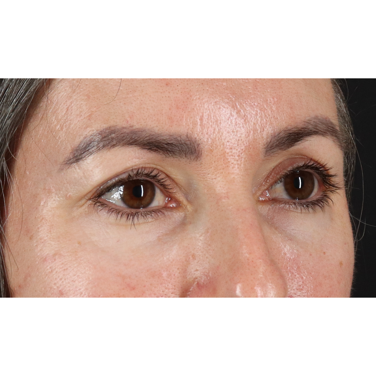 Eyelid Surgery Before & After Patient #3356