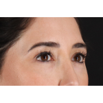 Eyelid Surgery Before & After Patient #3358