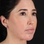 Structural Fat Grafting Before & After Patient #3649