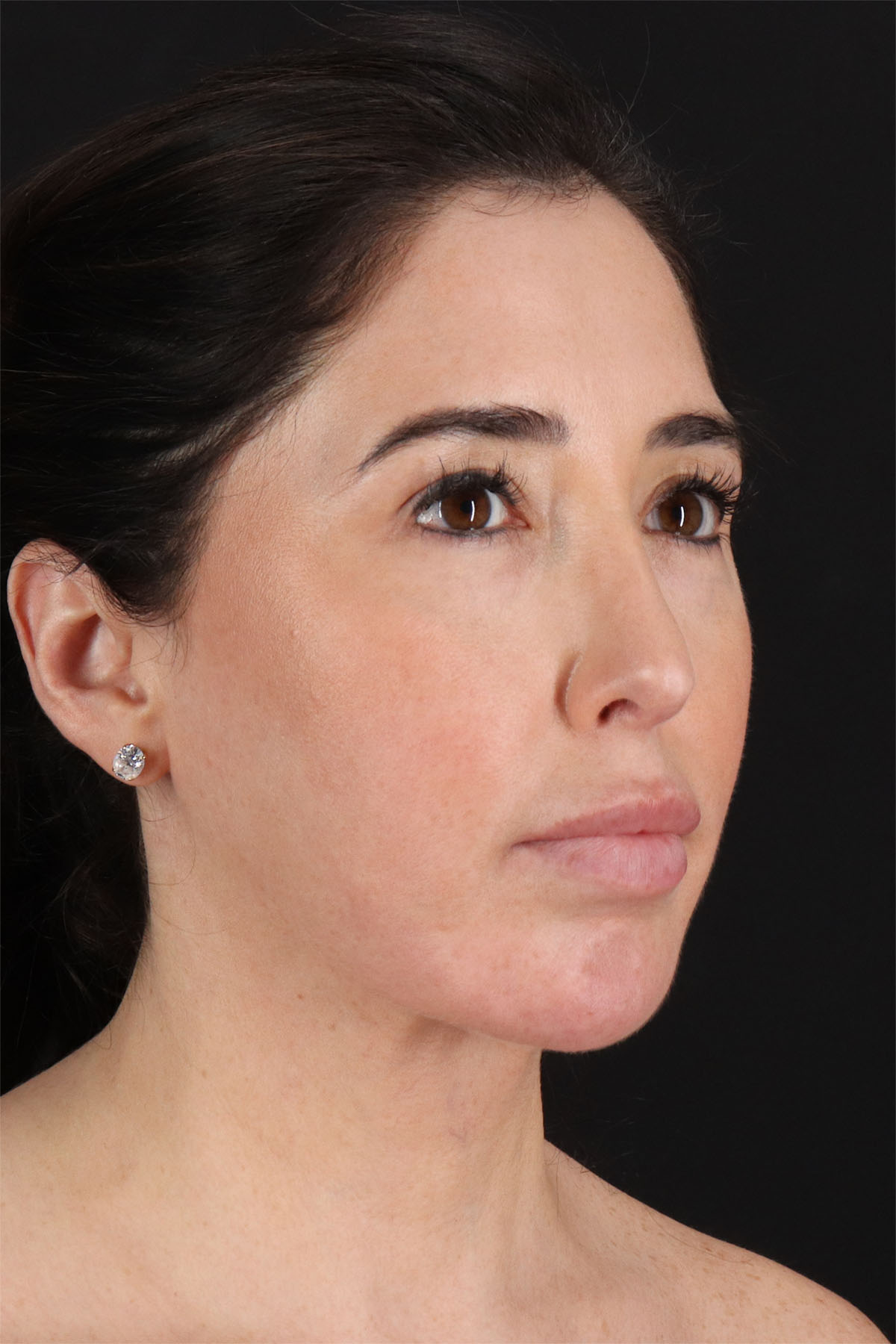 Structural Fat Grafting Before & After Patient #3649