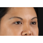 Brow Lift Before & After Patient #3114