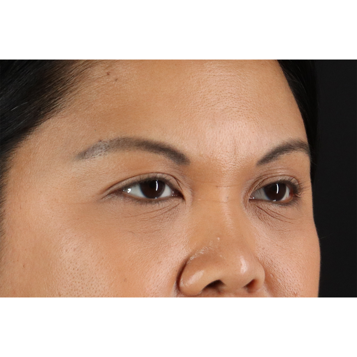 Brow Lift Before & After Patient #3114