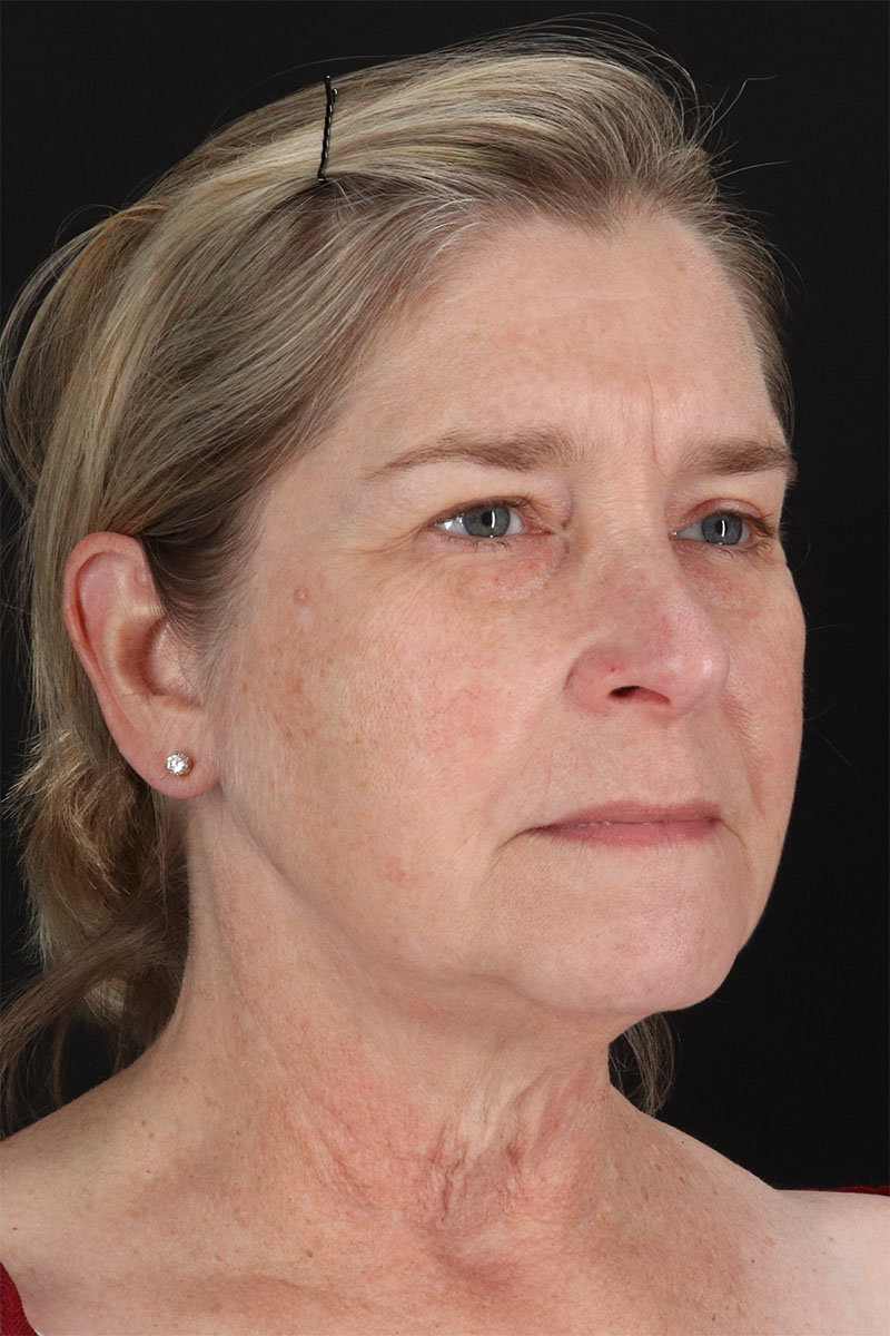 CO2 Laser Before & After Patient #3116