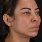 Laser Before & After Patient #3359
