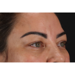 Eyelid Surgery Before & After Patient #3360