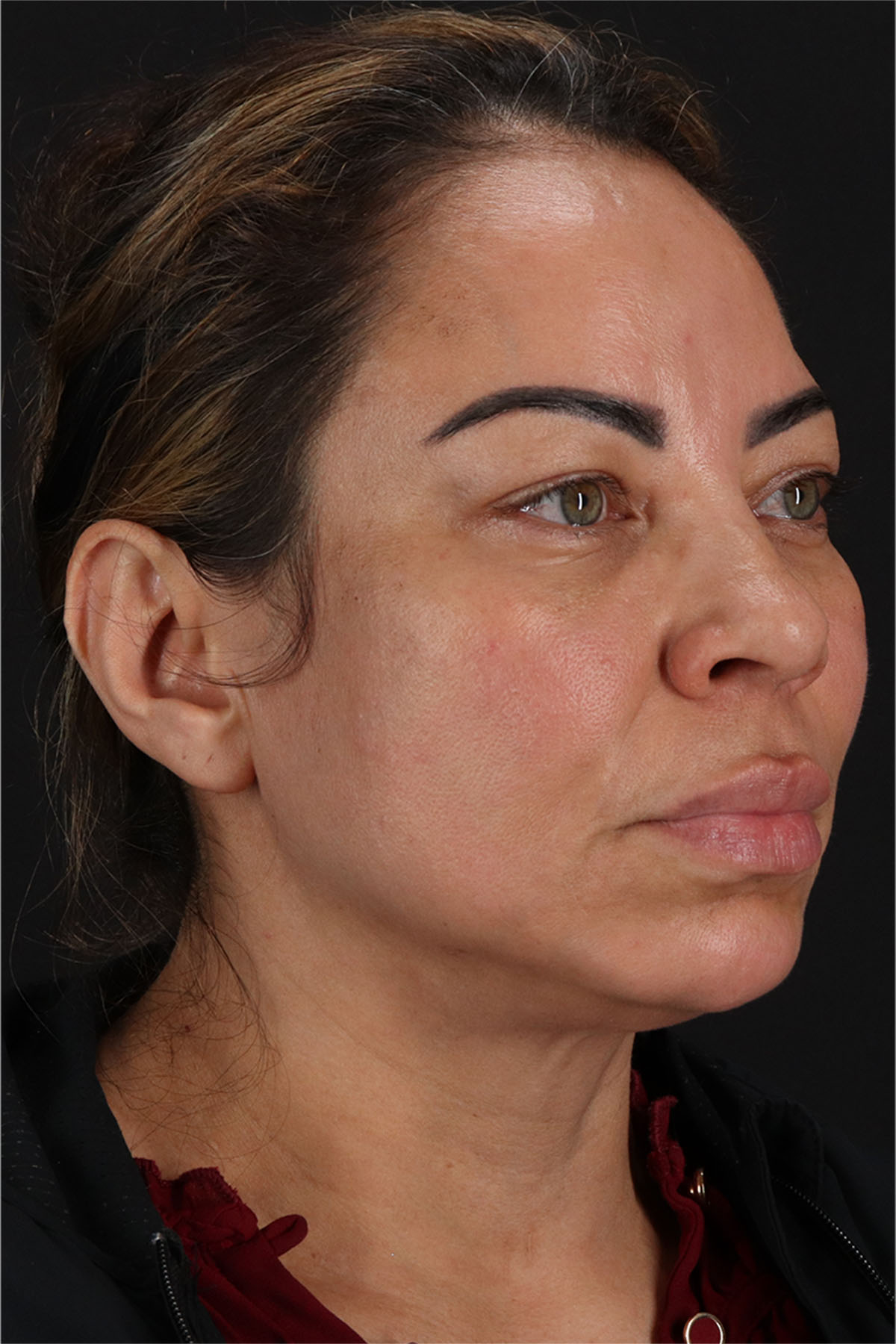 Laser Before & After Patient #3359