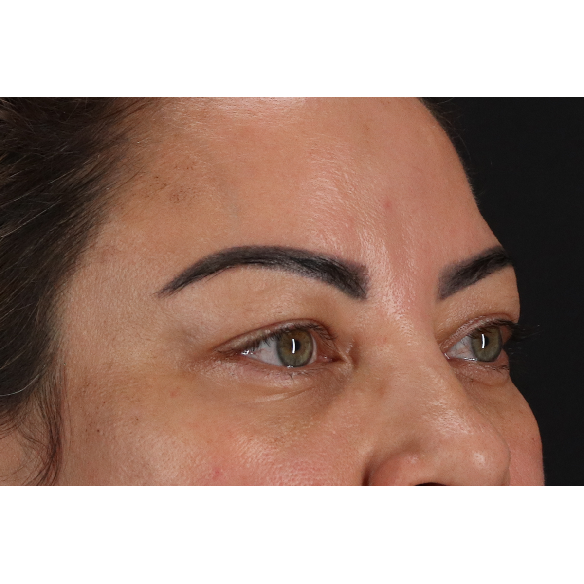 Eyelid Surgery Before & After Patient #3360
