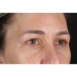 Eyelid Surgery Before & After Patient #3361