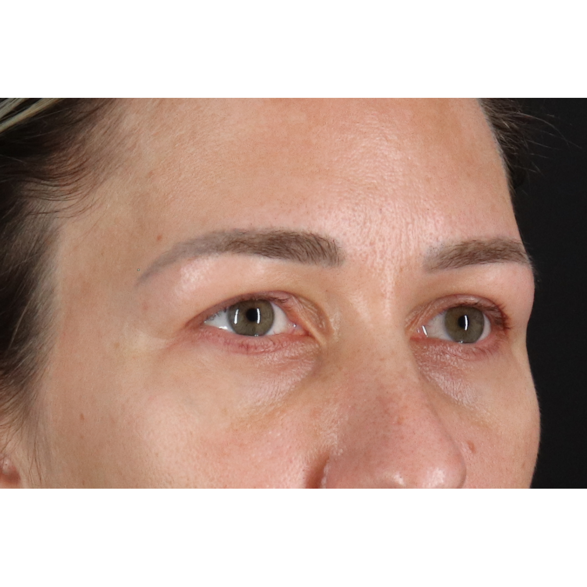 Eyelid Surgery Before & After Patient #3361