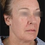 Laser Before & After Patient #3362