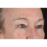 Eyelid Surgery Before & After Patient #3363