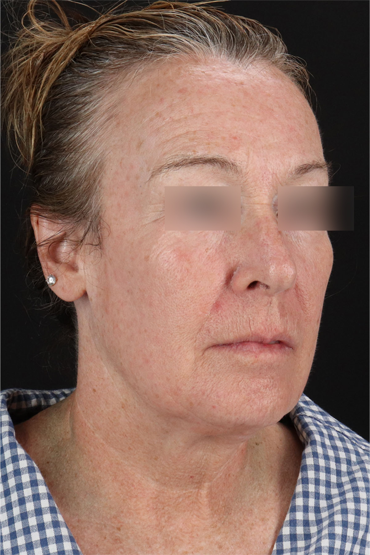 Laser Before & After Patient #3362