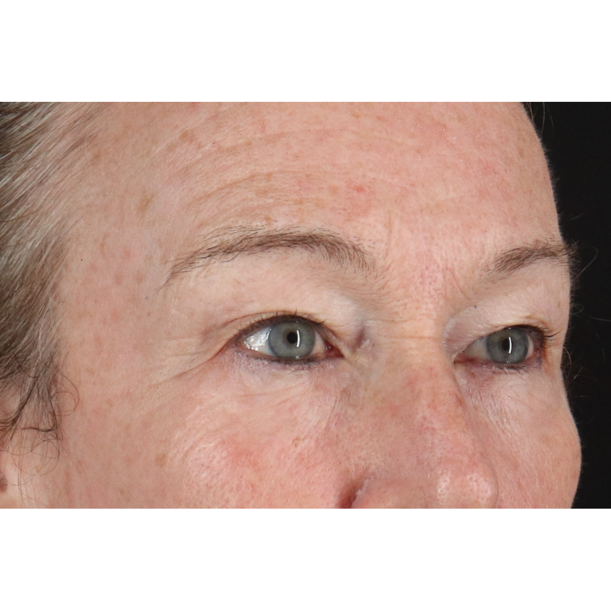 Eyelid Surgery Before & After Patient #3363