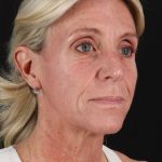 Ponytail Facelift Before & After Patient #3118
