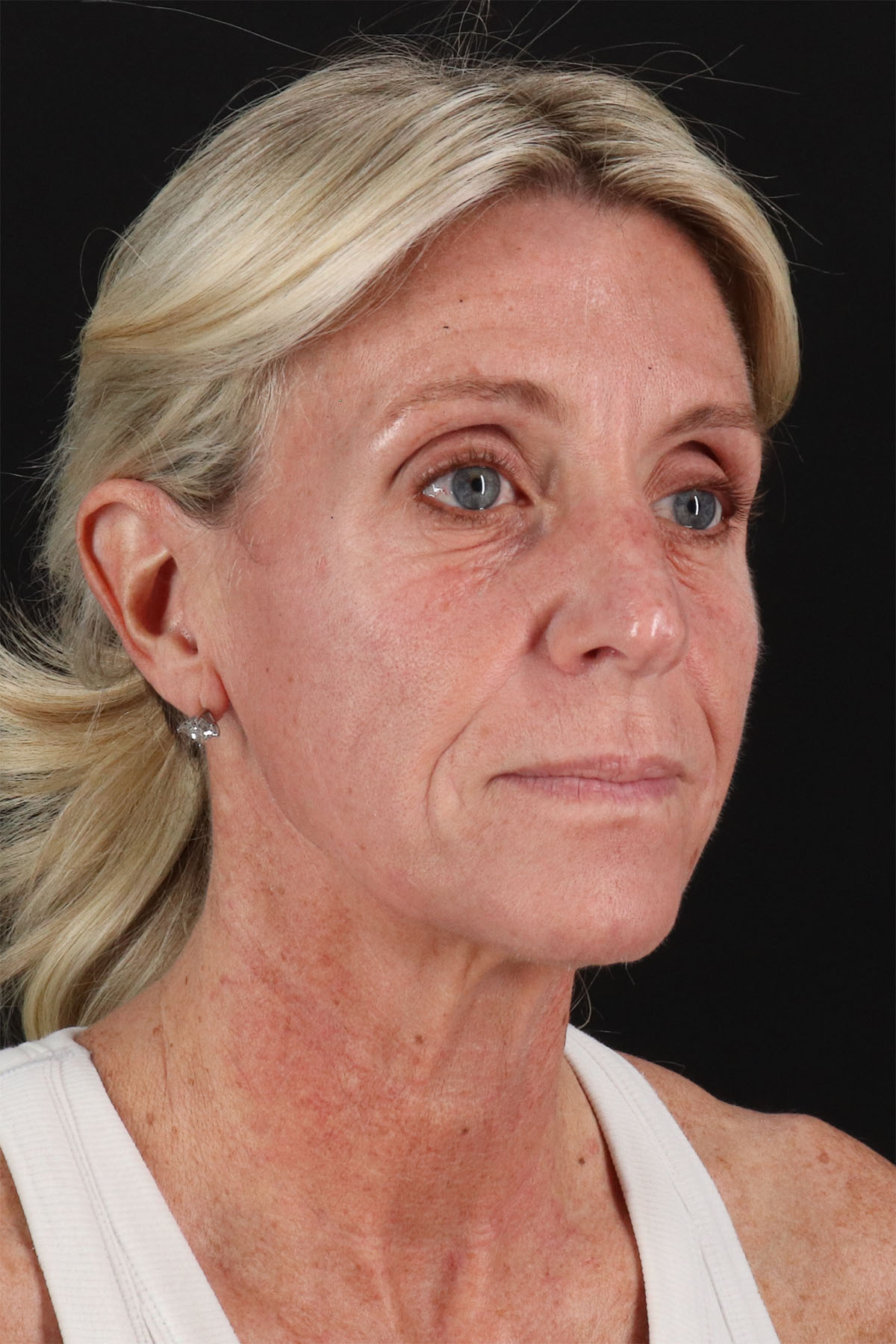 Ponytail Facelift Before & After Patient #3118
