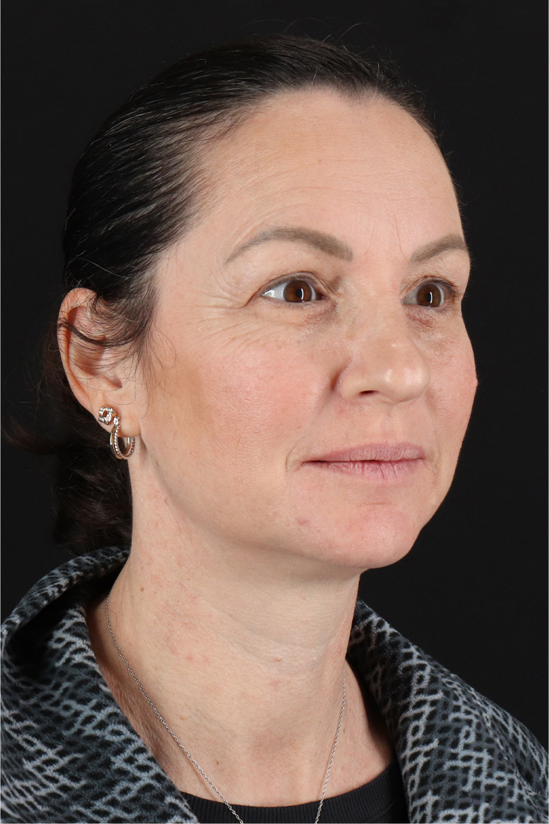 Chemical Peel Before & After Patient #3470