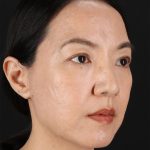 Skin Resurfacing / Laser Before & After Patient #3001