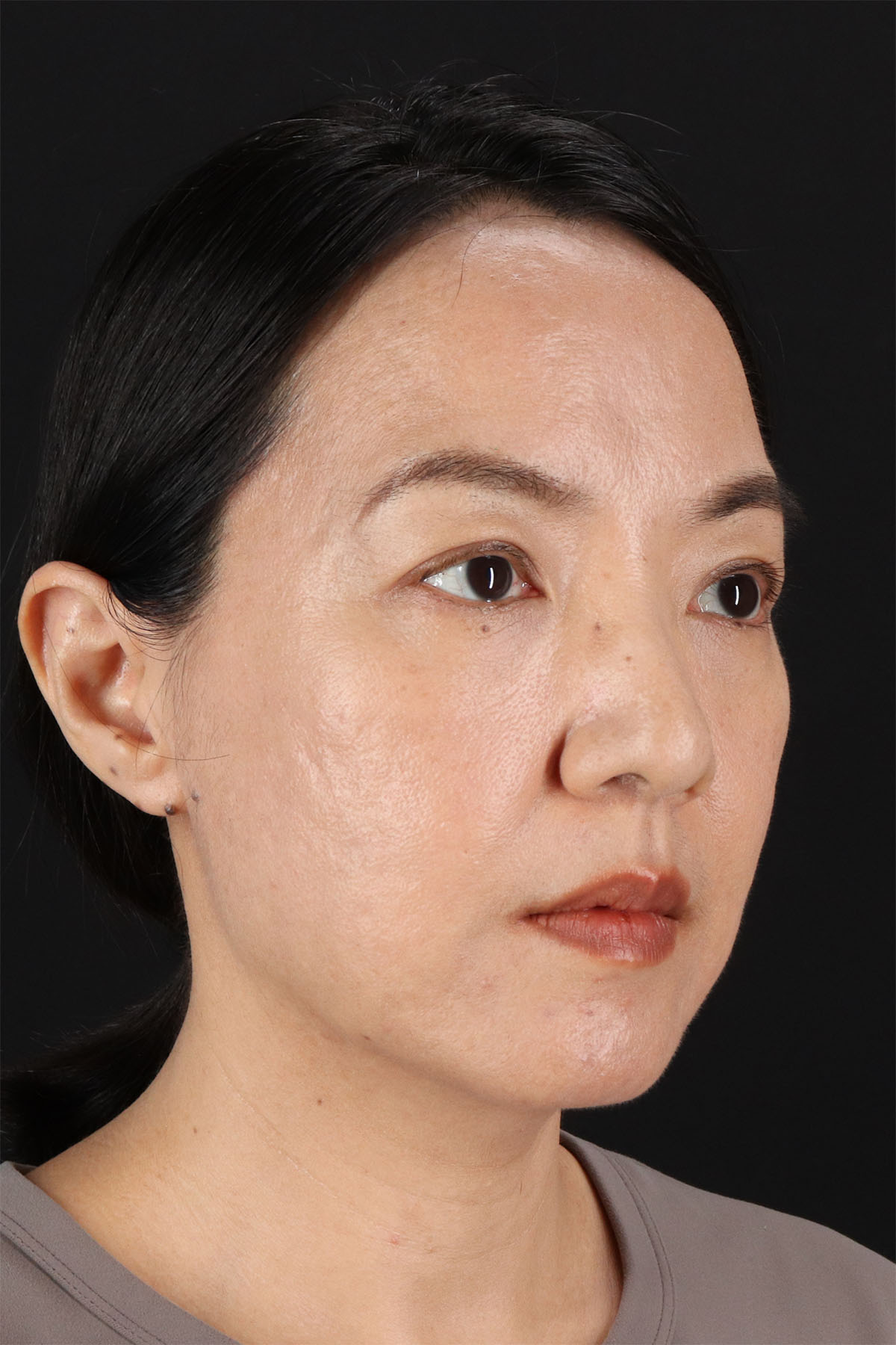 Skin Resurfacing / Laser Before & After Patient #3001